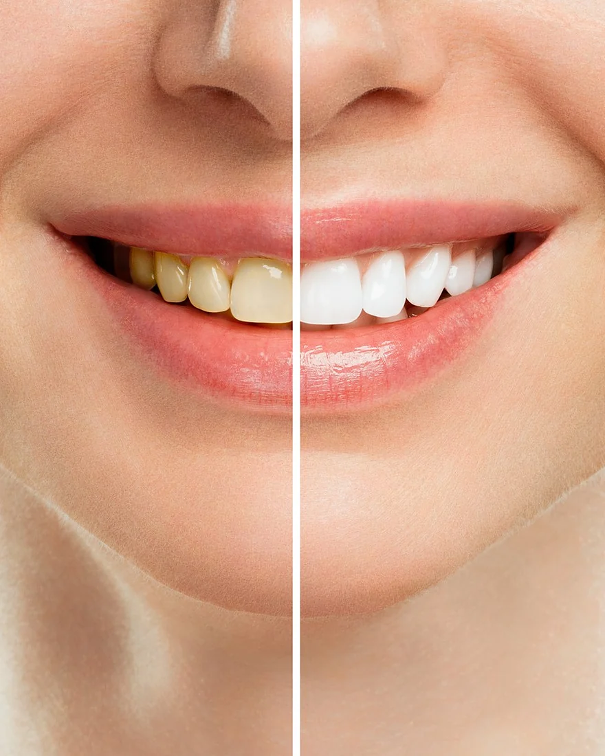 Antes y después de un blanqueamiento dental