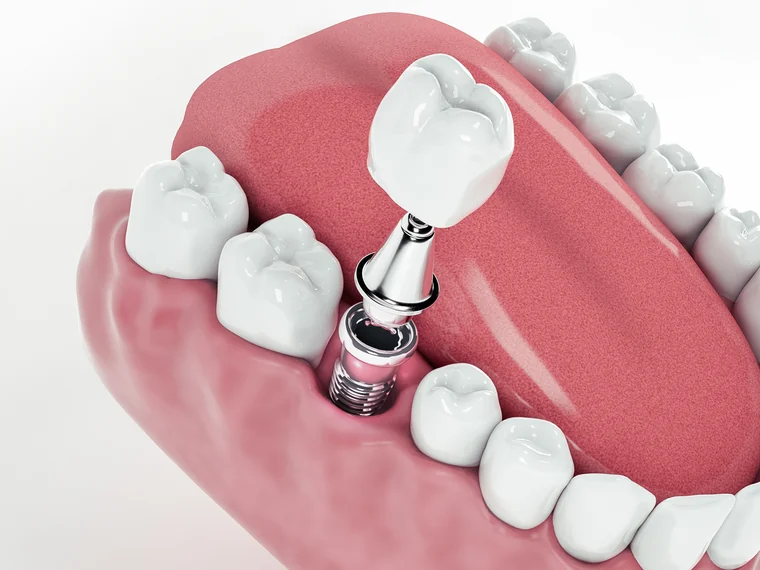 Prótesis dentales fijas