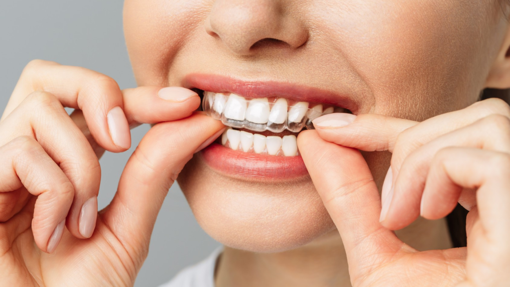 lineadores transparentes Invisalign en DentPrax Playa del Carmen