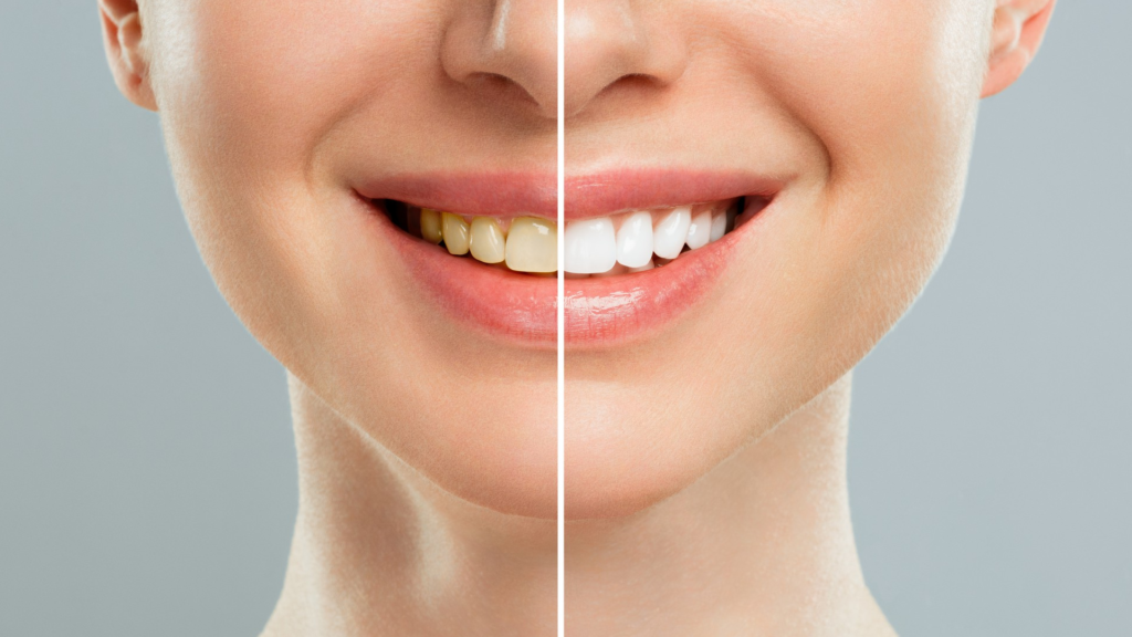 Paciente sonriendo después de un tratamiento de blanqueamiento dental en DentPrax