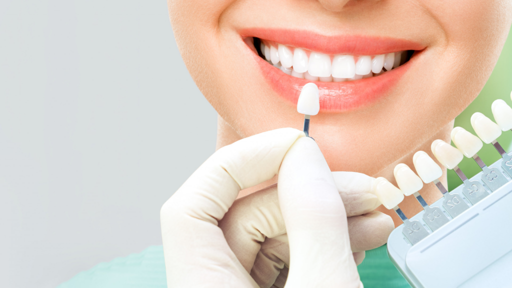 Carillas dentales de zirconia y resina